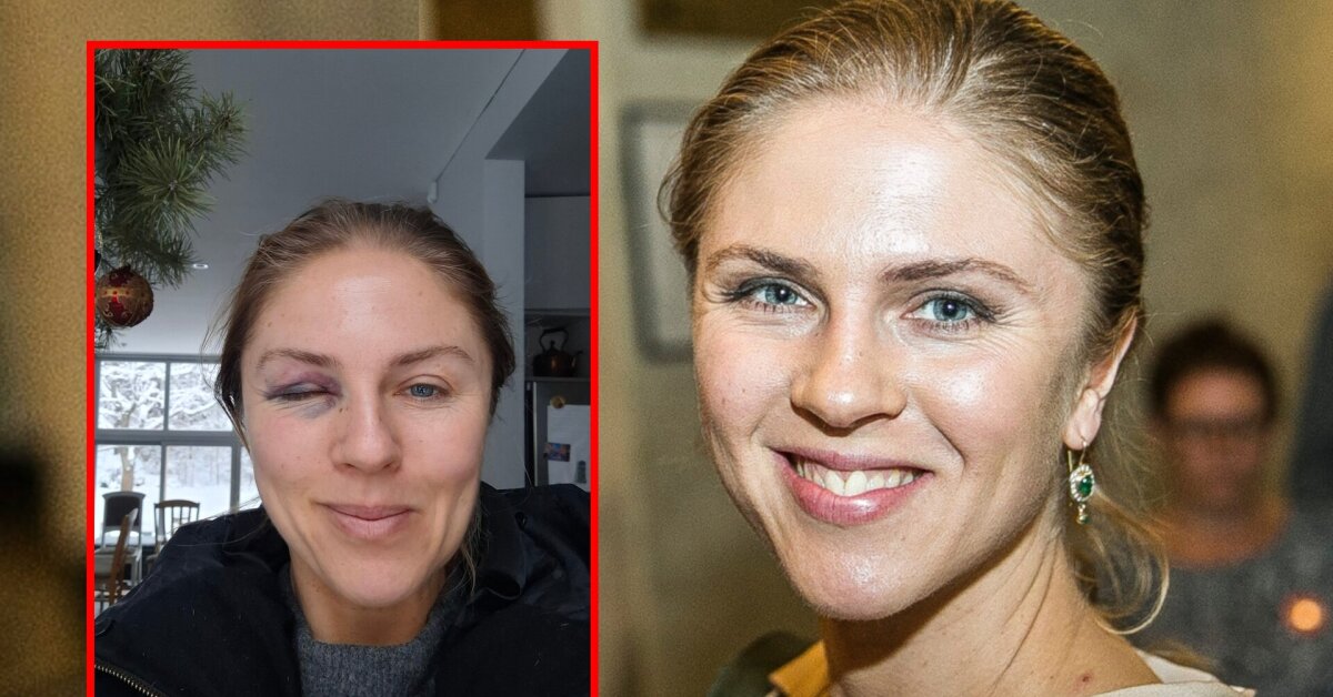 Editos Užaitės nuotrauka su „mėlyna“ akimi – suglumino: atskleidė, kas nutiko | Vardai