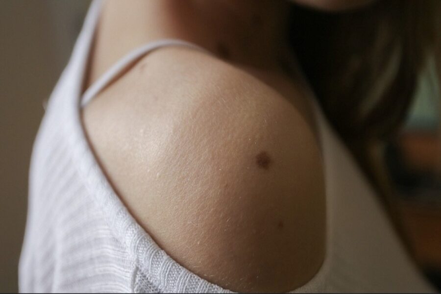 Eņģeļu un nē eņģeļu paraksti: ko var pastāstīt dzimumzīmes un dzimumplankumi