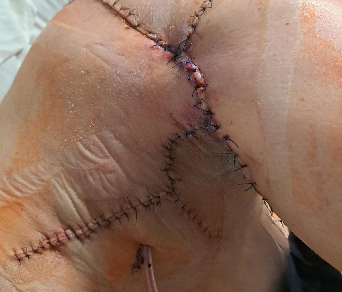 Medicīnas māsai Salacgrīvā uzbrūk pacientes suņi un saplosa ķermeni līdz nepazīšanai