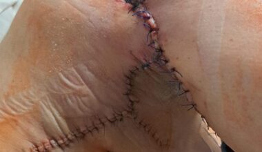 Medicīnas māsai Salacgrīvā uzbrūk pacientes suņi un saplosa ķermeni līdz nepazīšanai