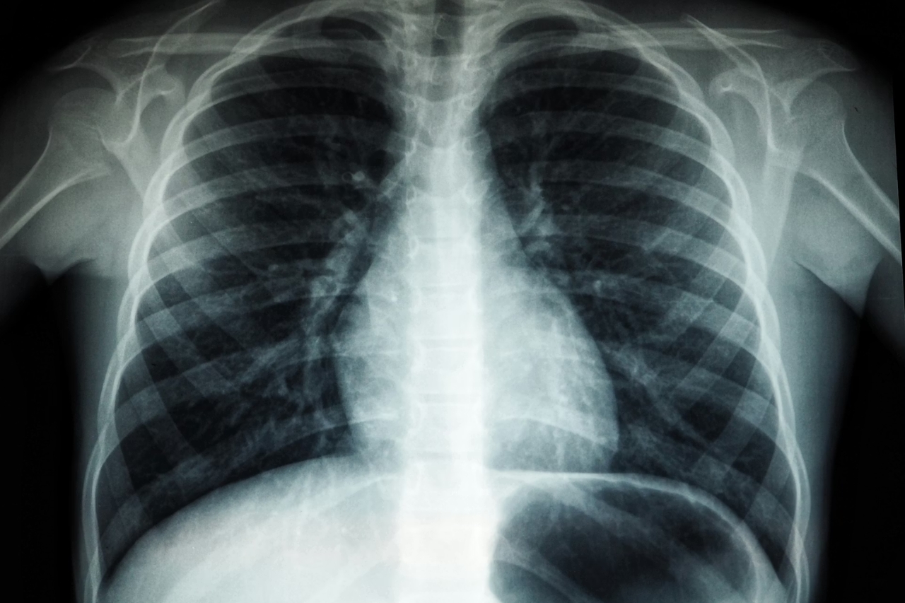 Norvēģijas kroņprincesei vajadzīga plaušu transplantācija