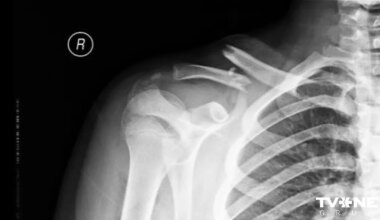 Vai Rūdolfu, Madaru un Ralfu ar atslēgas kaulu lūzumiem aizsūtīja mājās pamatoti?