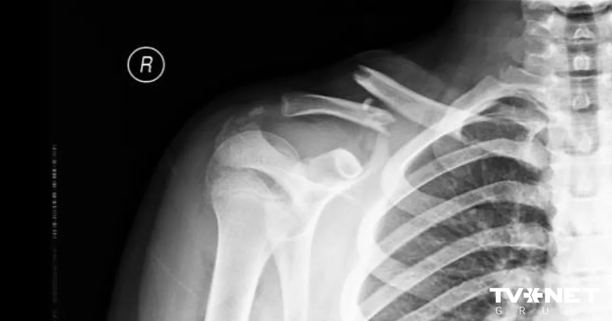 Vai Rūdolfu, Madaru un Ralfu ar atslēgas kaulu lūzumiem aizsūtīja mājās pamatoti?