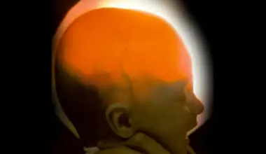 Neiroloģiskās slimības dēļ gandrīz bez smadzenēm dzimuša meitene nosvinējusi 20. dzimšanas dienu