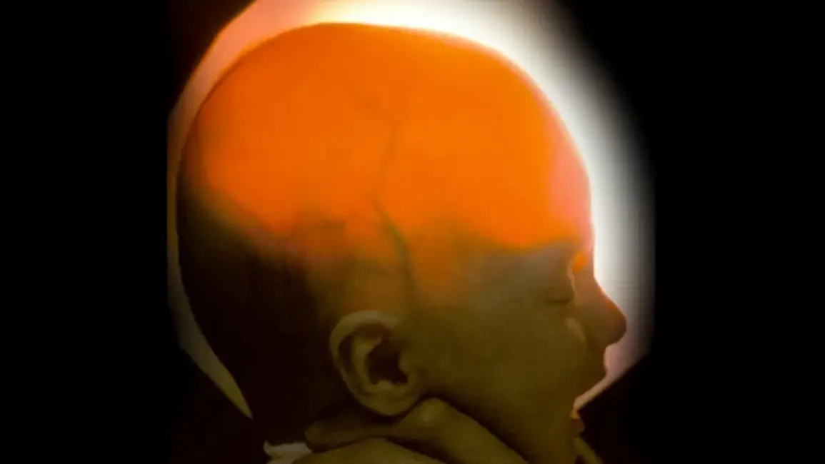 Neiroloģiskās slimības dēļ gandrīz bez smadzenēm dzimuša meitene nosvinējusi 20. dzimšanas dienu