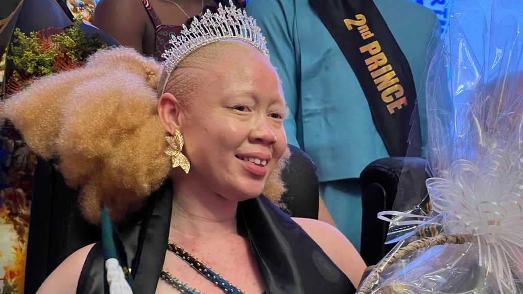 Mensen met albinisme strijden voor zichtbaarheid in Afrika