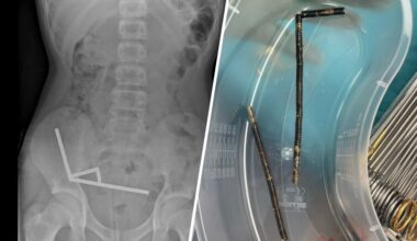 Nieuw-Zeelandse tiener slikt tientallen magneten in, deel darmen verwijderd