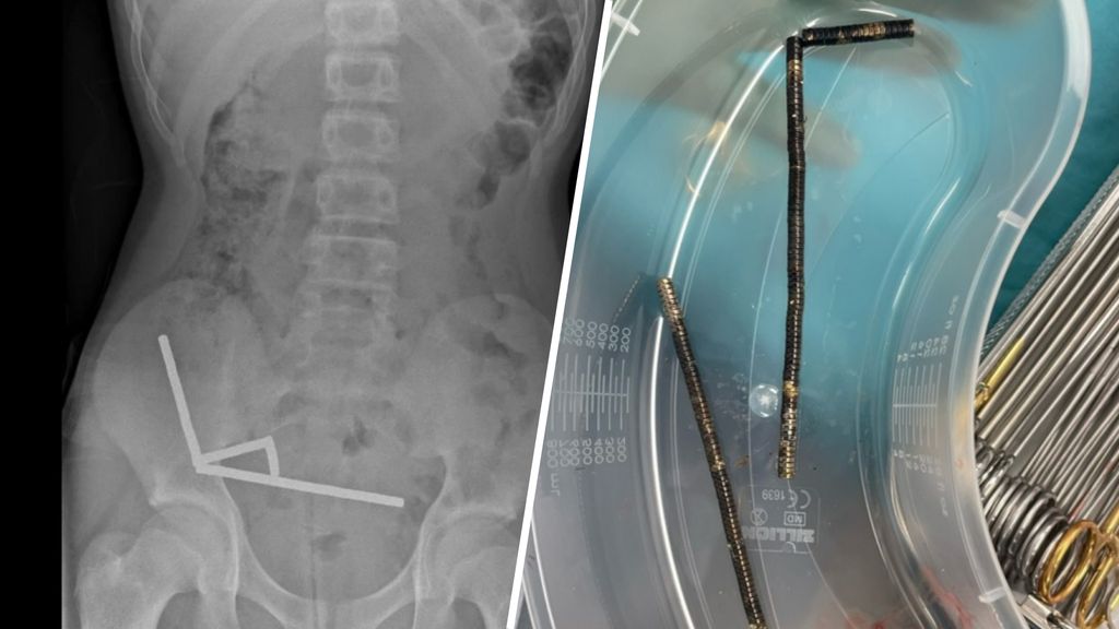 Nieuw-Zeelandse tiener slikt tientallen magneten in, deel darmen verwijderd