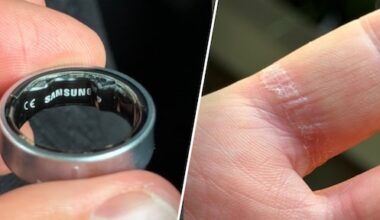 Samsung Ring zwelt op, zit vast aan vinger: man moet naar ziekenhuis