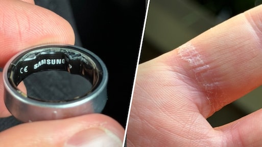 Samsung Ring zwelt op, zit vast aan vinger: man moet naar ziekenhuis