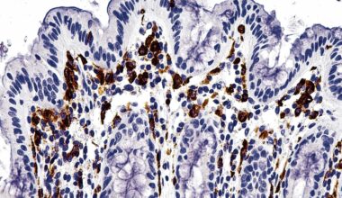 In China draagt een waterbacterie bij aan ontstaan van een chronische darmziekte