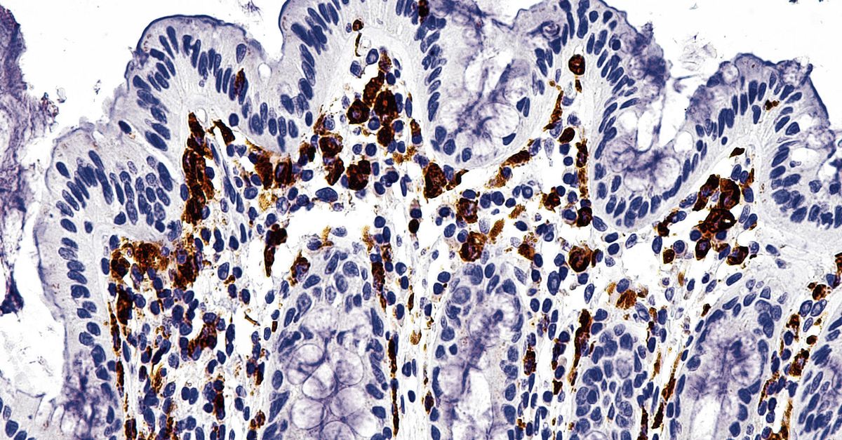 In China draagt een waterbacterie bij aan ontstaan van een chronische darmziekte