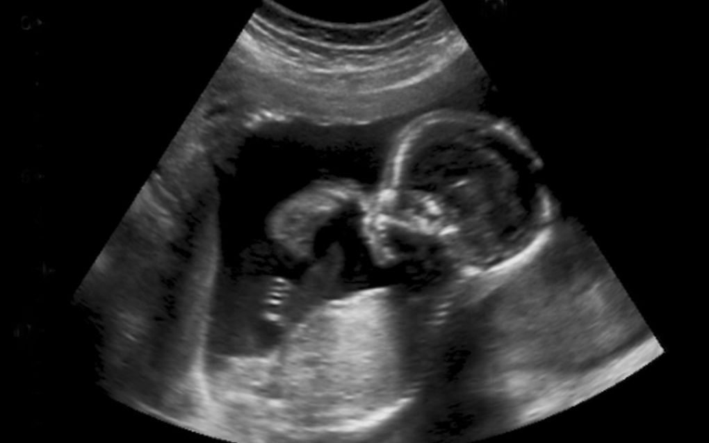 Foetus van 24 weken krijgt „niet standaard” verdoving bij abortus; SGP stelt Kamervragen