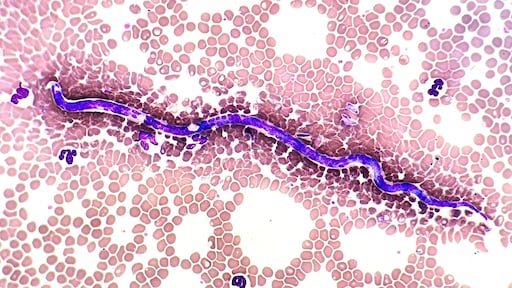 Arts haalt 11 centimeter lange worm uit ooglid Roemeense vrouw