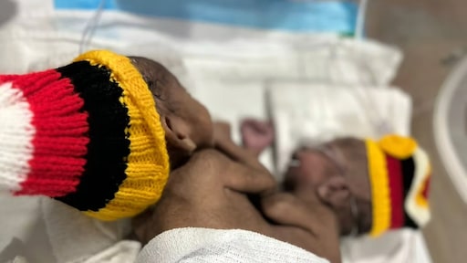 Risicovolle scheiding Siamese tweeling mislukt in Australië: baby Tom overleden