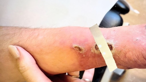 Zorgen om gewonde daklozen in vrieskou: 'Geen toegankelijke opvang' - RTL.nl