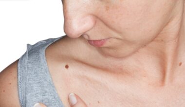 Deel inwoners Katwijk heeft tot 70 procent meer kans op melanoom door erfelijk gen