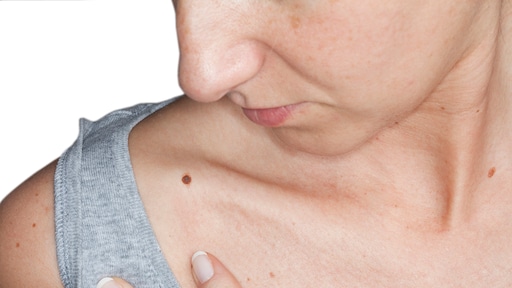 Deel inwoners Katwijk heeft tot 70 procent meer kans op melanoom door erfelijk gen