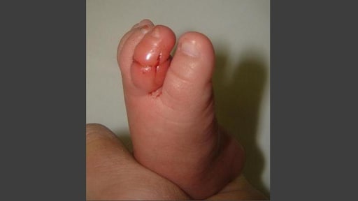 Verpleegkundige waarschuwt na bijna-amputatie door 'haartourniquetsyndroom'