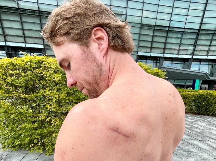 Skulderskaden plager Aaleksander Amodt Kilde fortsatt: – Frustrerende