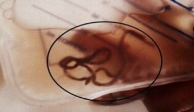 Gjorde sjokkfunn i urinposen