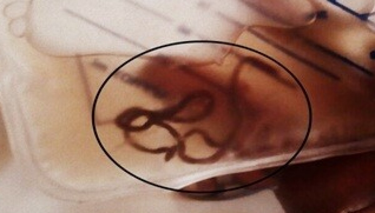 Gjorde sjokkfunn i urinposen