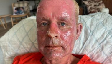 Brannmesteren i Meråker fikk forbrent ansiktet under øvelse