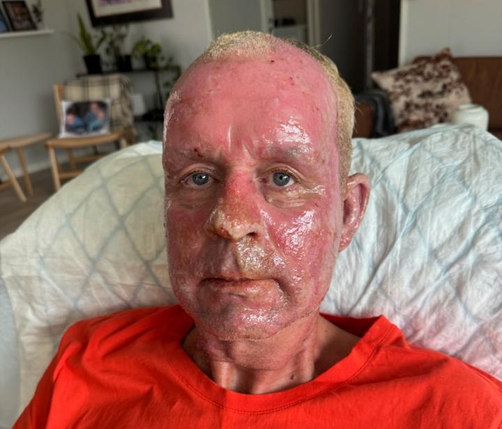 Brannmesteren i Meråker fikk forbrent ansiktet under øvelse