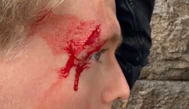 Ole Thomas Hansen avslører blodig el-sparkesykkelulykke