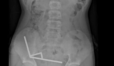 Temu: Tenåringsgutt svelget 100 magneter