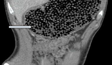 Leger advarer om populære vannperler: Tenåring kunne dødd