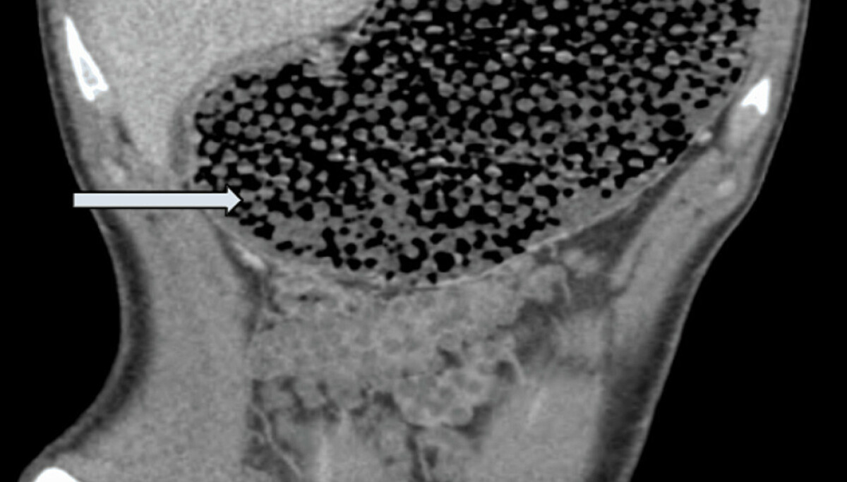Leger advarer om populære vannperler: Tenåring kunne dødd