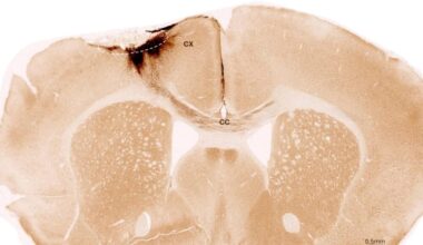 Forskere har klart det ingen trodde var mulig etter hjerneslag