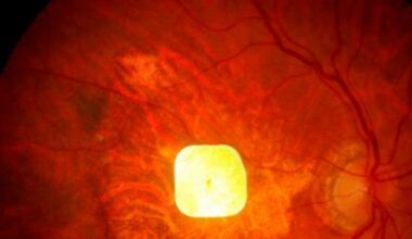 Blinde pasienter får for første gang tilbake leseevnen ved hjelp av et mikroskopisk implantat