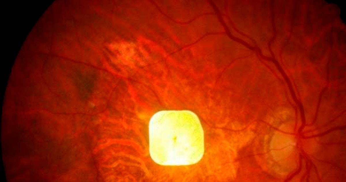 Blinde pasienter får for første gang tilbake leseevnen ved hjelp av et mikroskopisk implantat