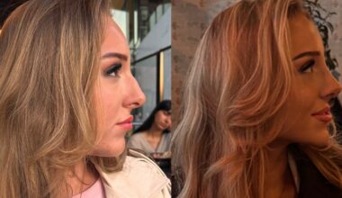 Elinor tok plastisk kirurgi i Tyrkia: Advarer