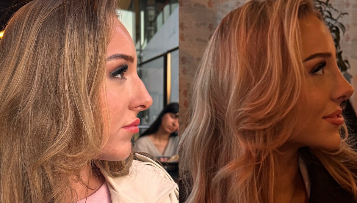 Elinor tok plastisk kirurgi i Tyrkia: Advarer