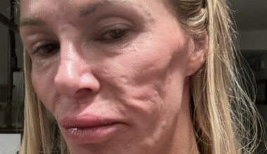 Brandi Glanville deler helseoppdatering etter sjokkerende hudproblemer