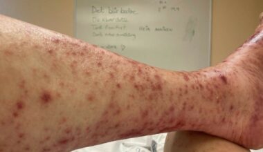 Fra halsbetennelse til ekstreme verkebyller