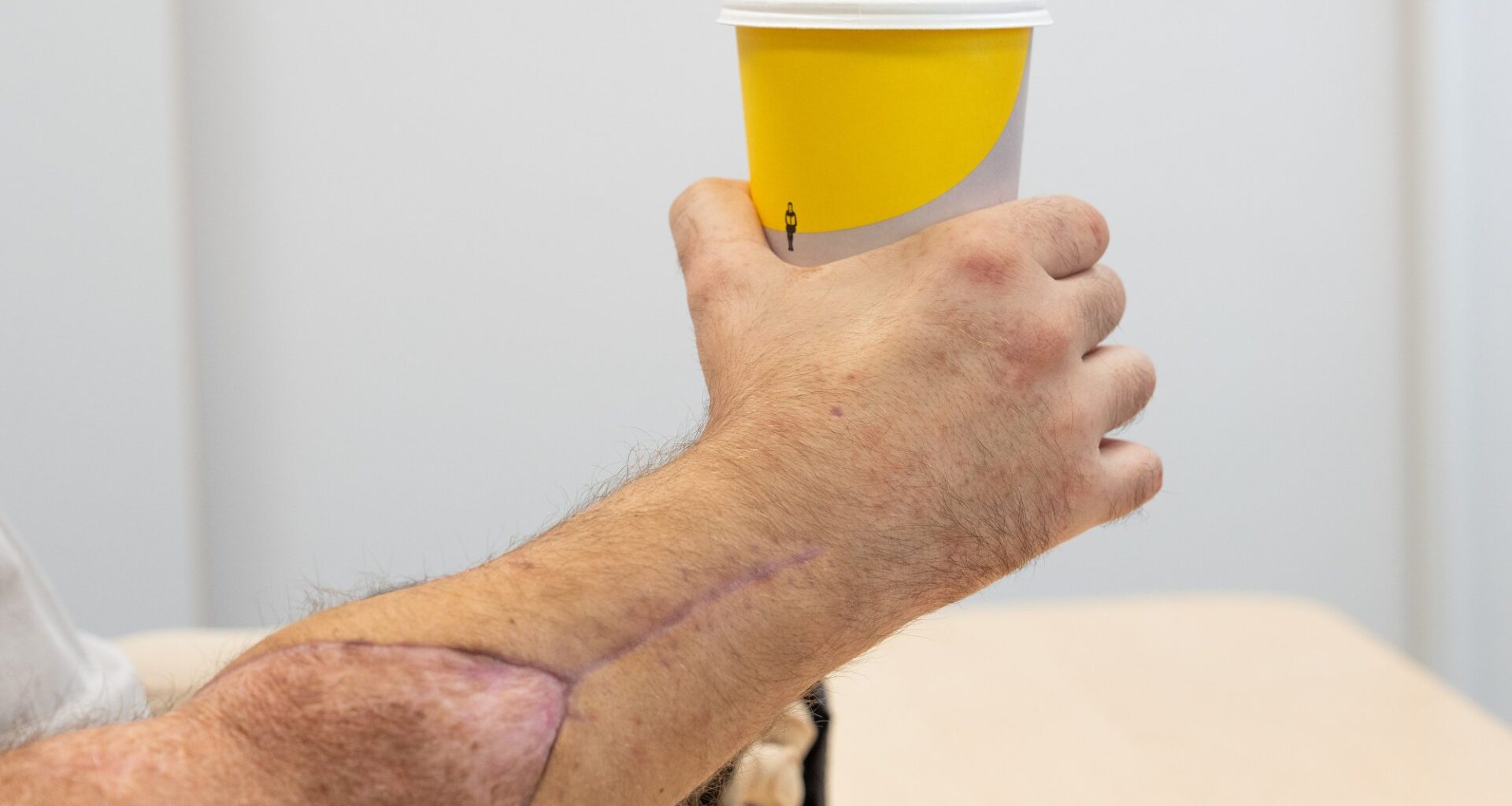 Transplantasjon, Sverige | Banebrytende operasjon i Sverige: Transplantasjon av hender gir lovende resultater