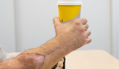 Transplantasjon, Sverige | Banebrytende operasjon i Sverige: Transplantasjon av hender gir lovende resultater