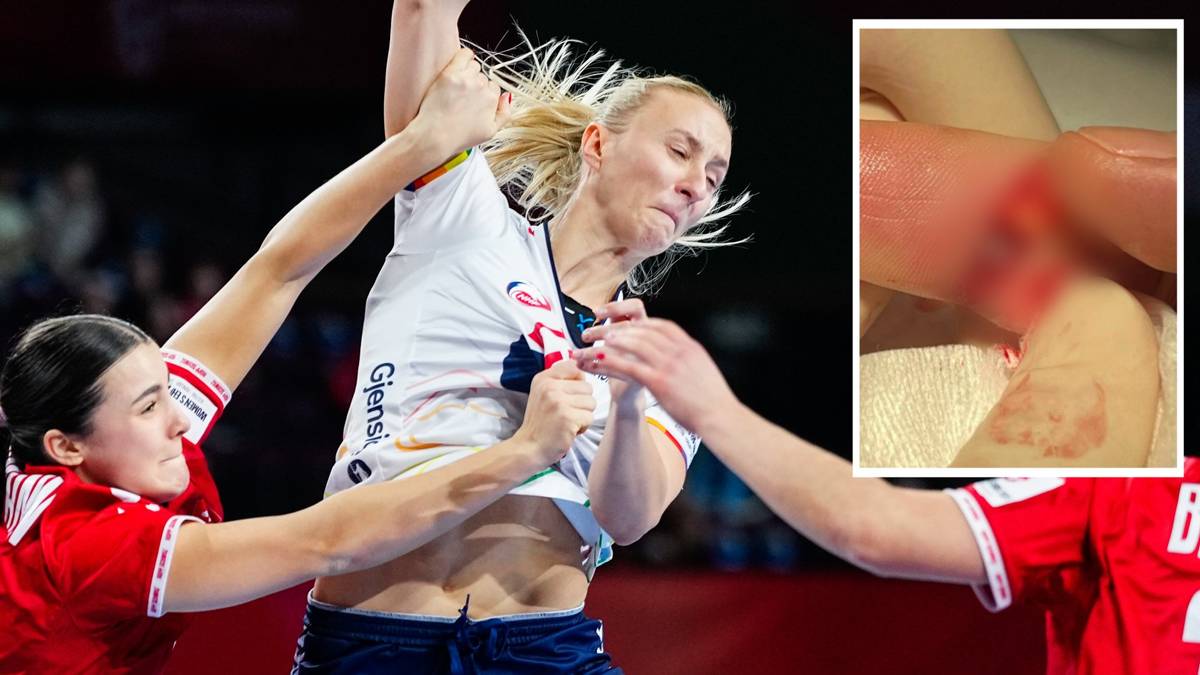 Henny Reistad med et bilde av en skadet finger innfelt