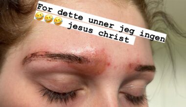 Lyko, Normal | Forbrukerrådet advarer mot vanlige Lyko og Normal-produkter: – Kjemisk forbrenning