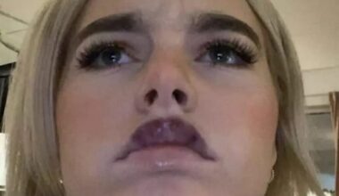 Isabella Shack: Advarer mot leppefillers