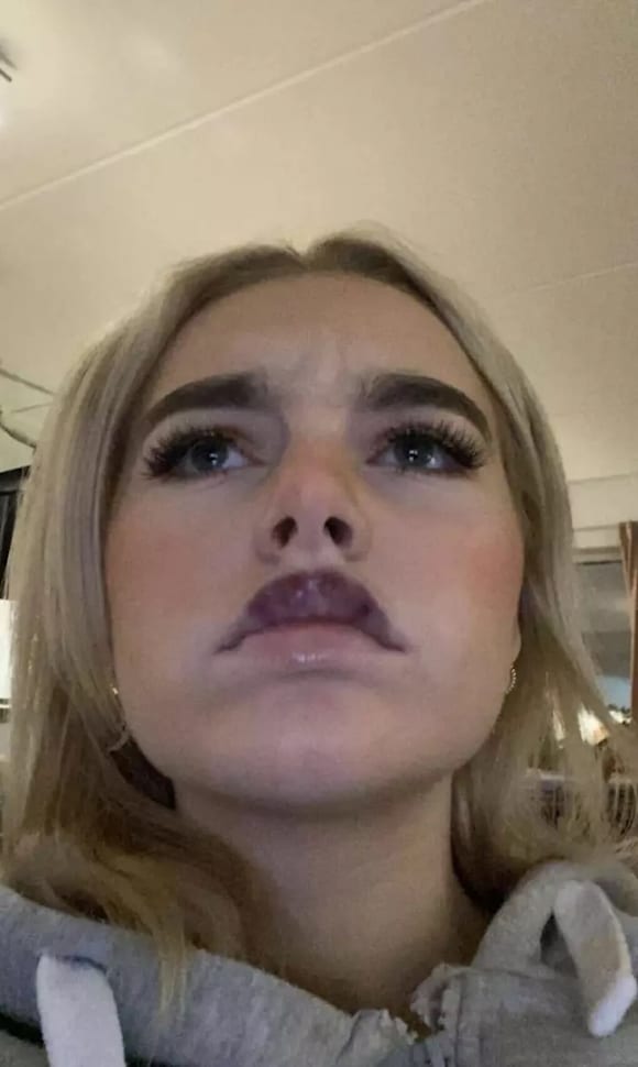 Isabella Shack: Advarer mot leppefillers