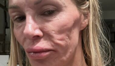 Brandi Glanville avslører diagnose etter ansiktsforvandling