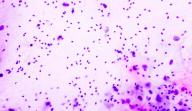 Sæddonor med kreft-mutasjon: 16 norske kvinner rammet