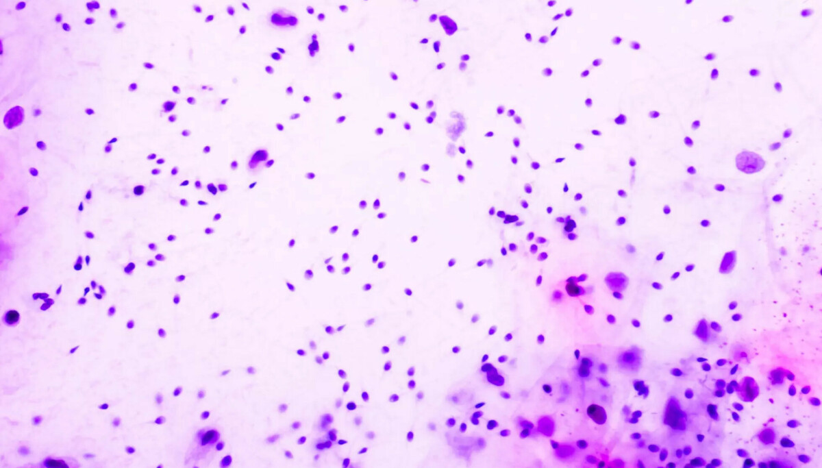 Sæddonor med kreft-mutasjon: 16 norske kvinner rammet