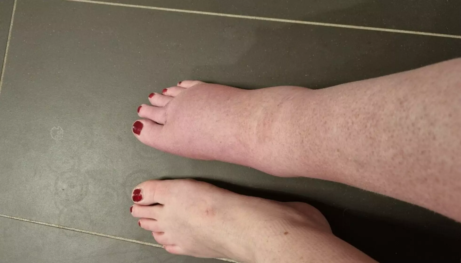 HEVELSE: Så stor er hevelsen i Beathe Vikestads bein - seks år etter et ankelbrudd i 2019. Beinet er ømtålig og tåler knapt berøring. Foto: Privat