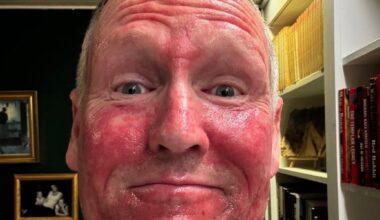 Danmark, Solkrem | Dansk politiker advarer: – Ansiktet mitt ser smadret ut